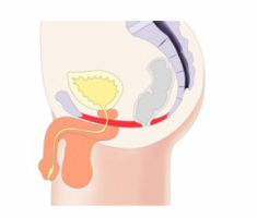 illustration of a man's pelvic floor after BTL Emsella treatment