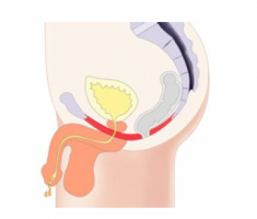 illustration of a man's weak pelvic floor