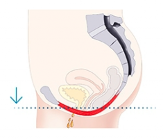Illustration of a woman's weak pelvic floor